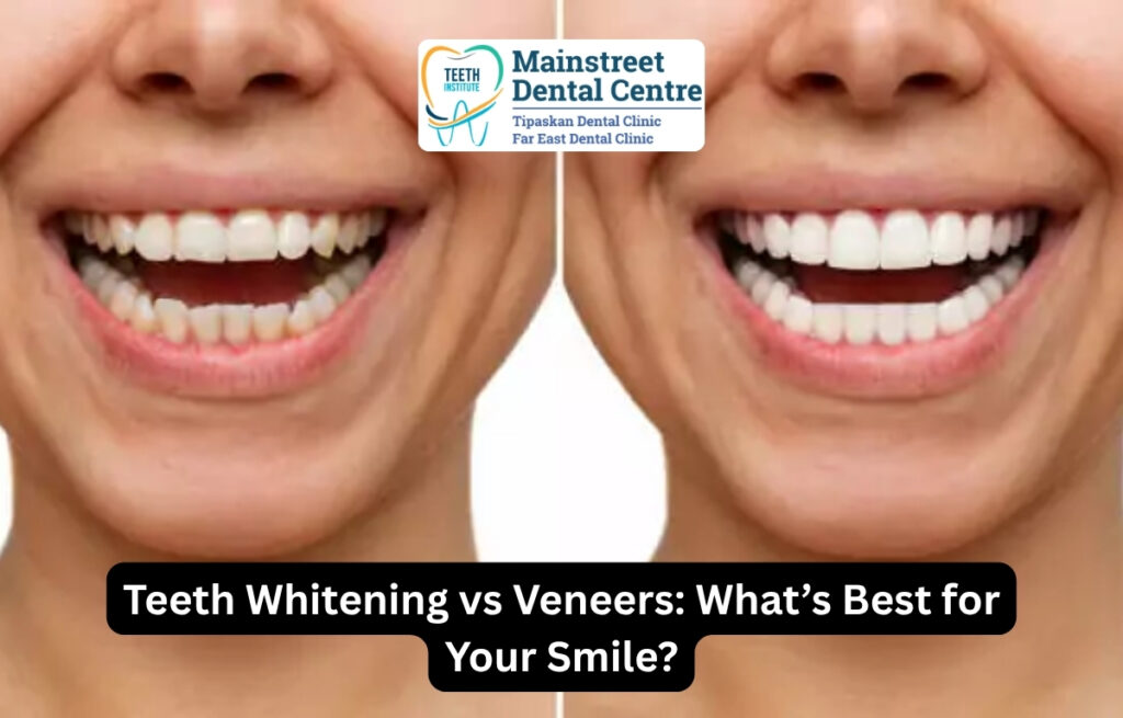 Teeth Whitening vs Veneers in Edmonton